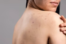 Back & Body Acne