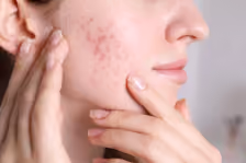 Acne & Breakouts