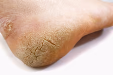 Cracked Heels