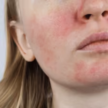 Sensitivity & Redness