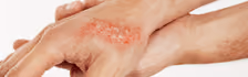 Burns & Wounds